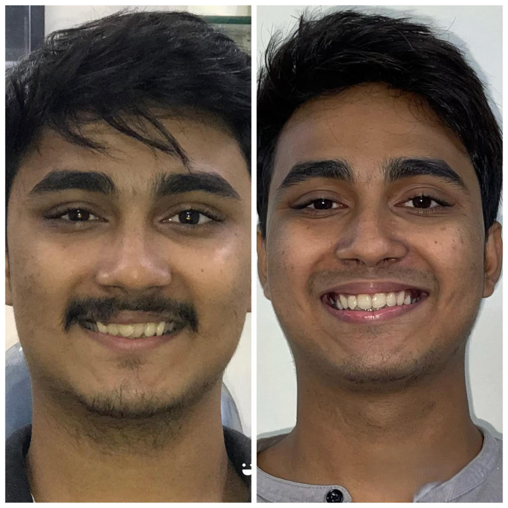 Custom Smile Design in Thane & Goregaon