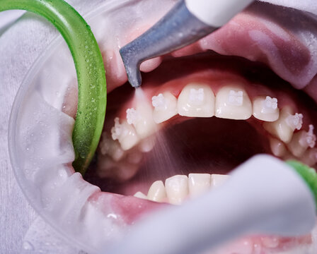 Professional dental cleaning in Thane and Goregaon – scaling and polishing