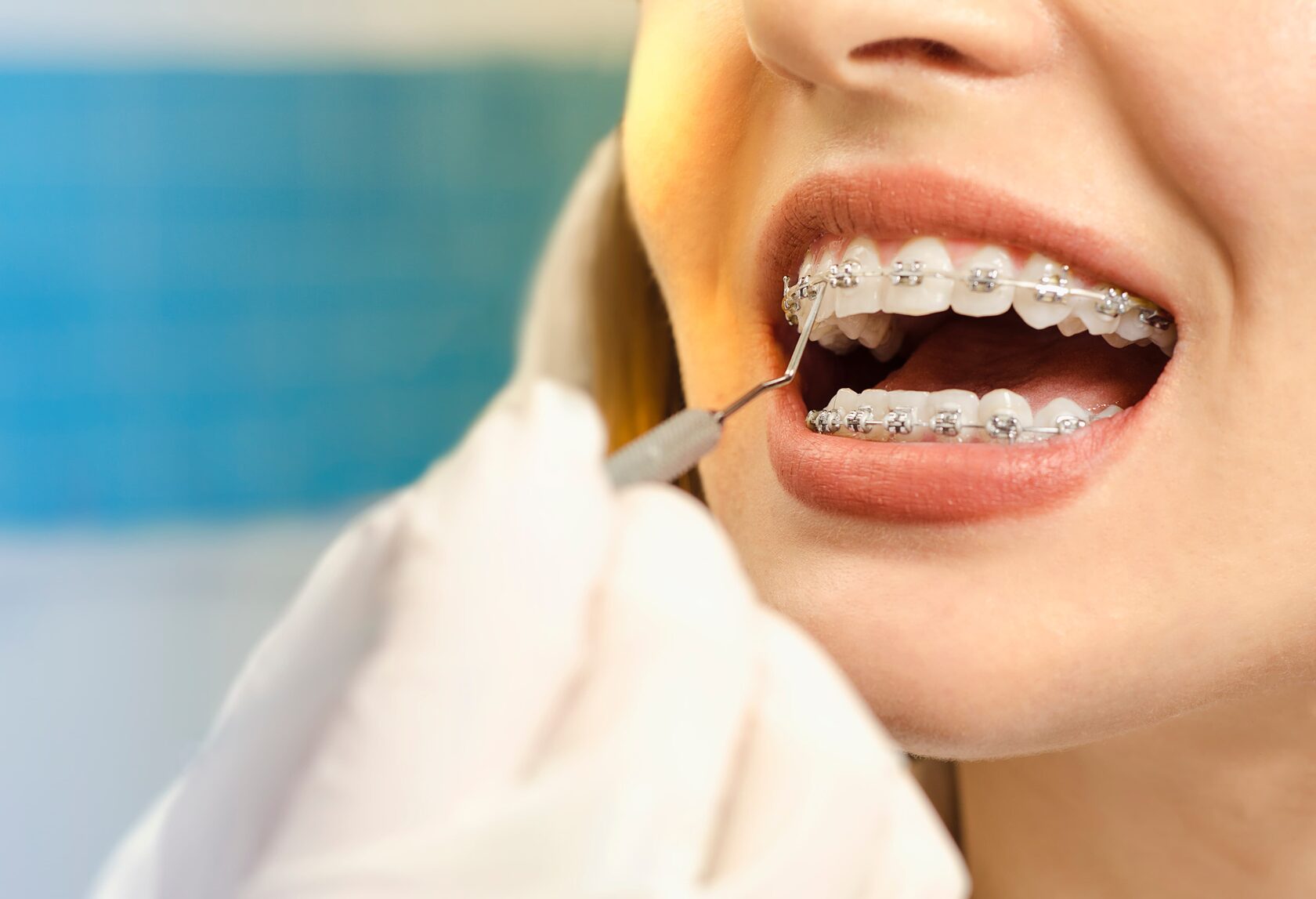 Braces treatment