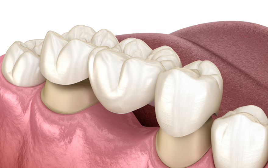 Dental crowns and bridges