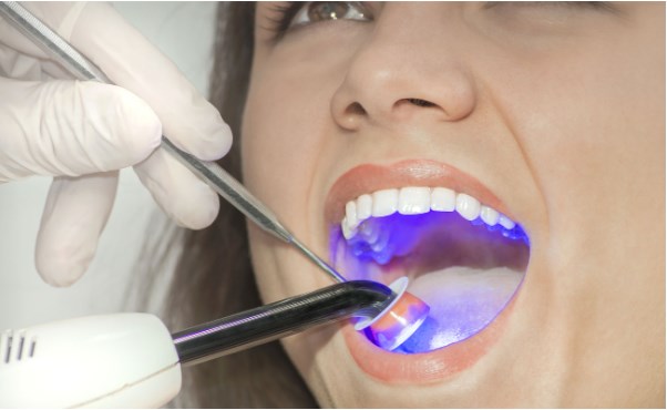 Dental fillings