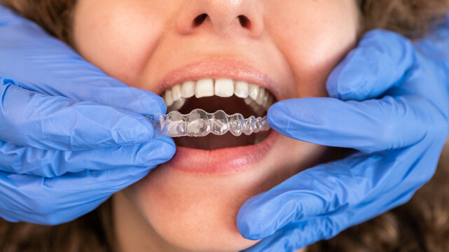 Invisalign Clear Aligners in Thane & Goregaon