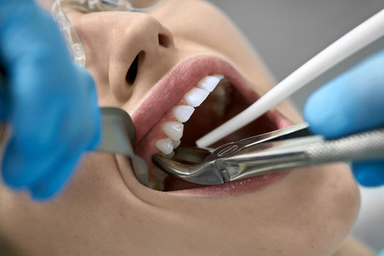 Tooth extractions